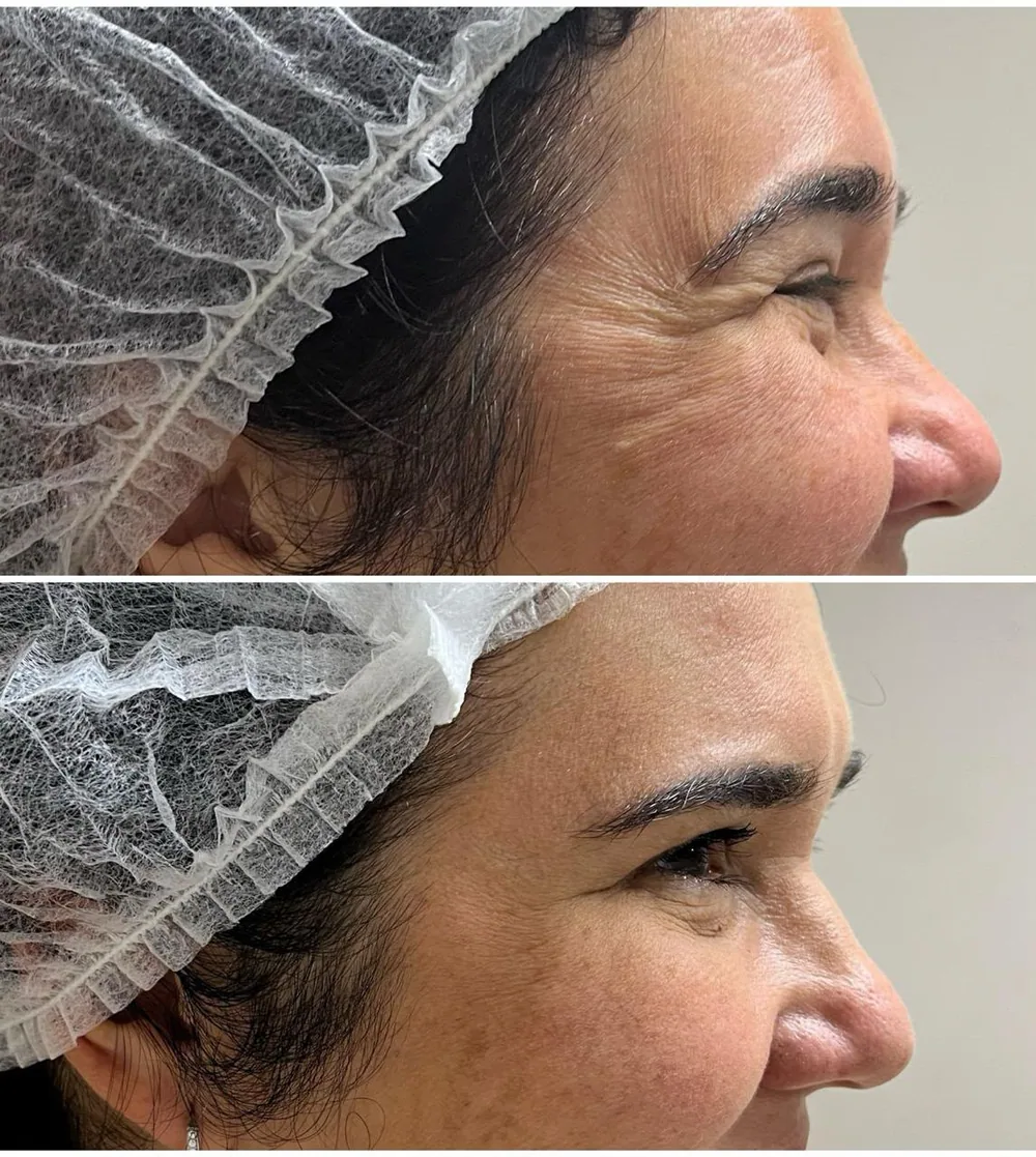 Toxina botulínica — testa e glabela