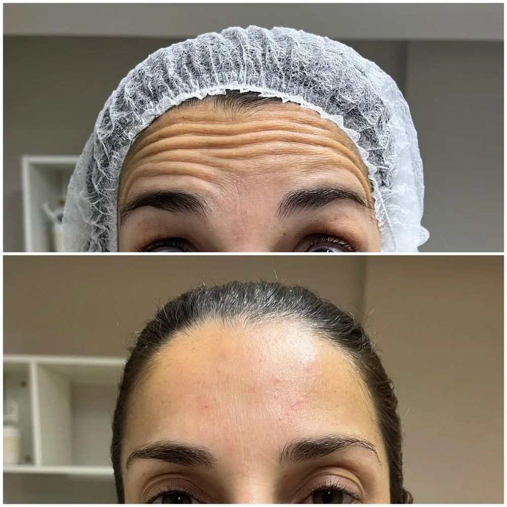 Toxina botulínica — região dos olhos