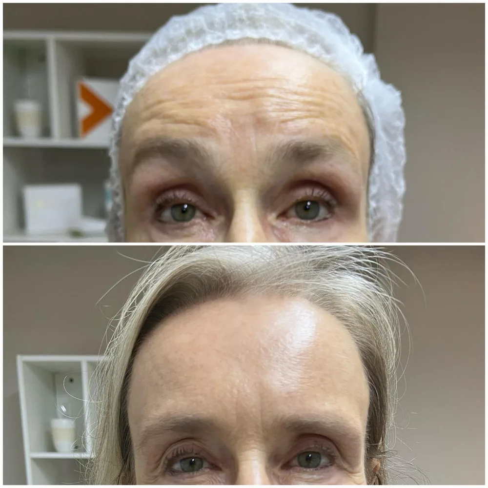 Toxina botulínica — região dos olhos