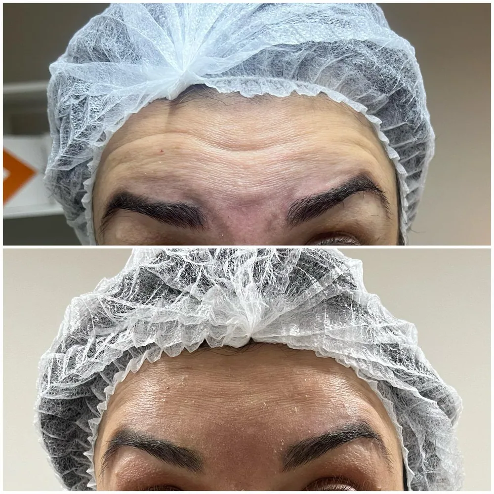 Toxina botulínica — testa e glabela