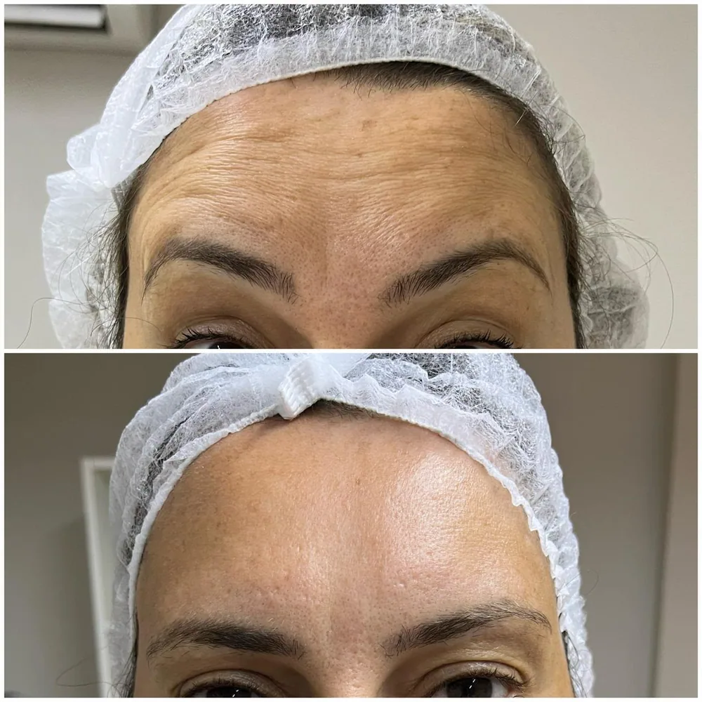 Toxina botulínica — região dos olhos