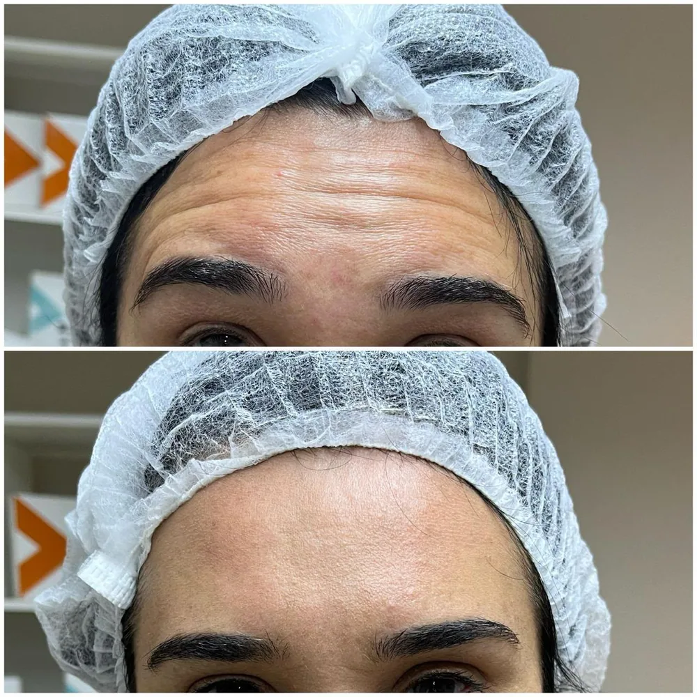Toxina botulínica — terço superior