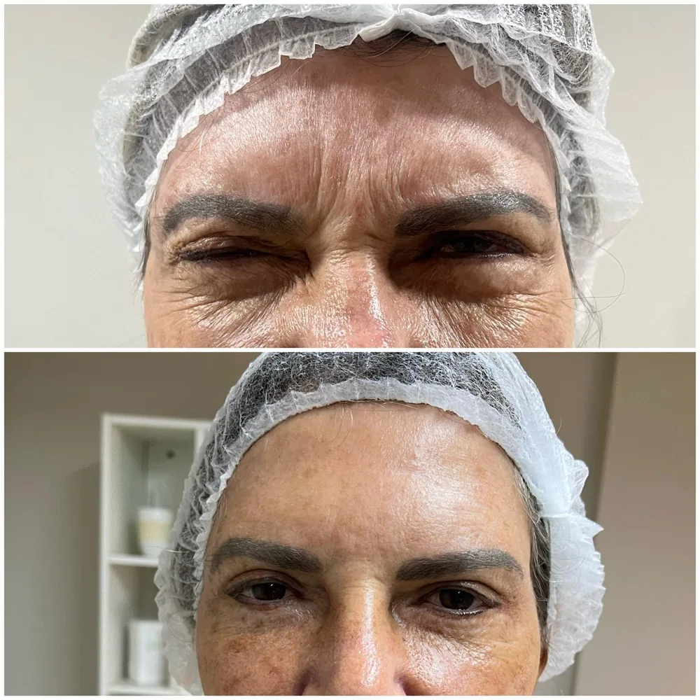 Toxina botulínica — região dos olhos