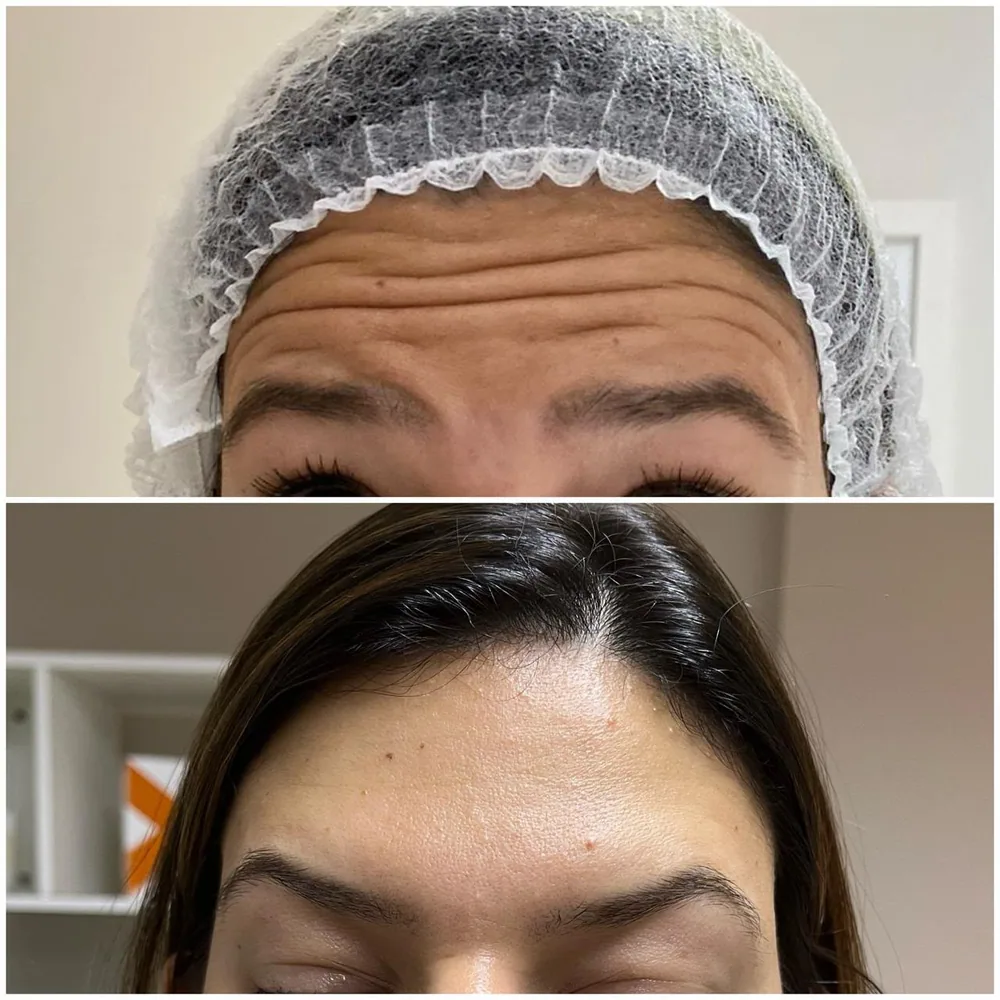 Toxina botulínica — terço superior