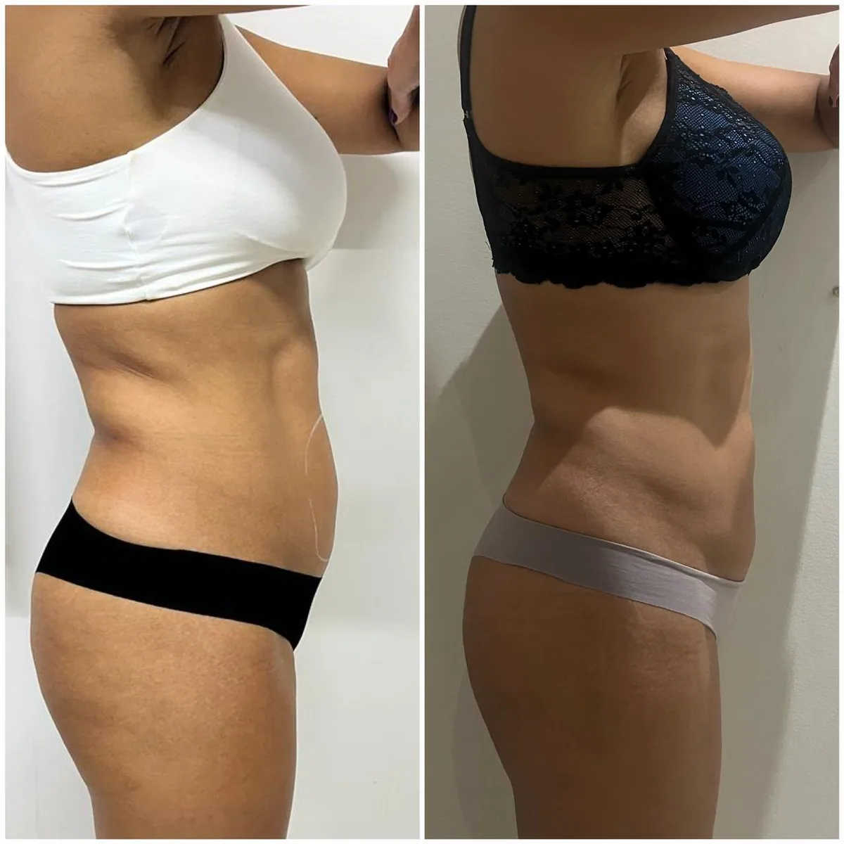 Contorno corporal — pós-protocolo completo