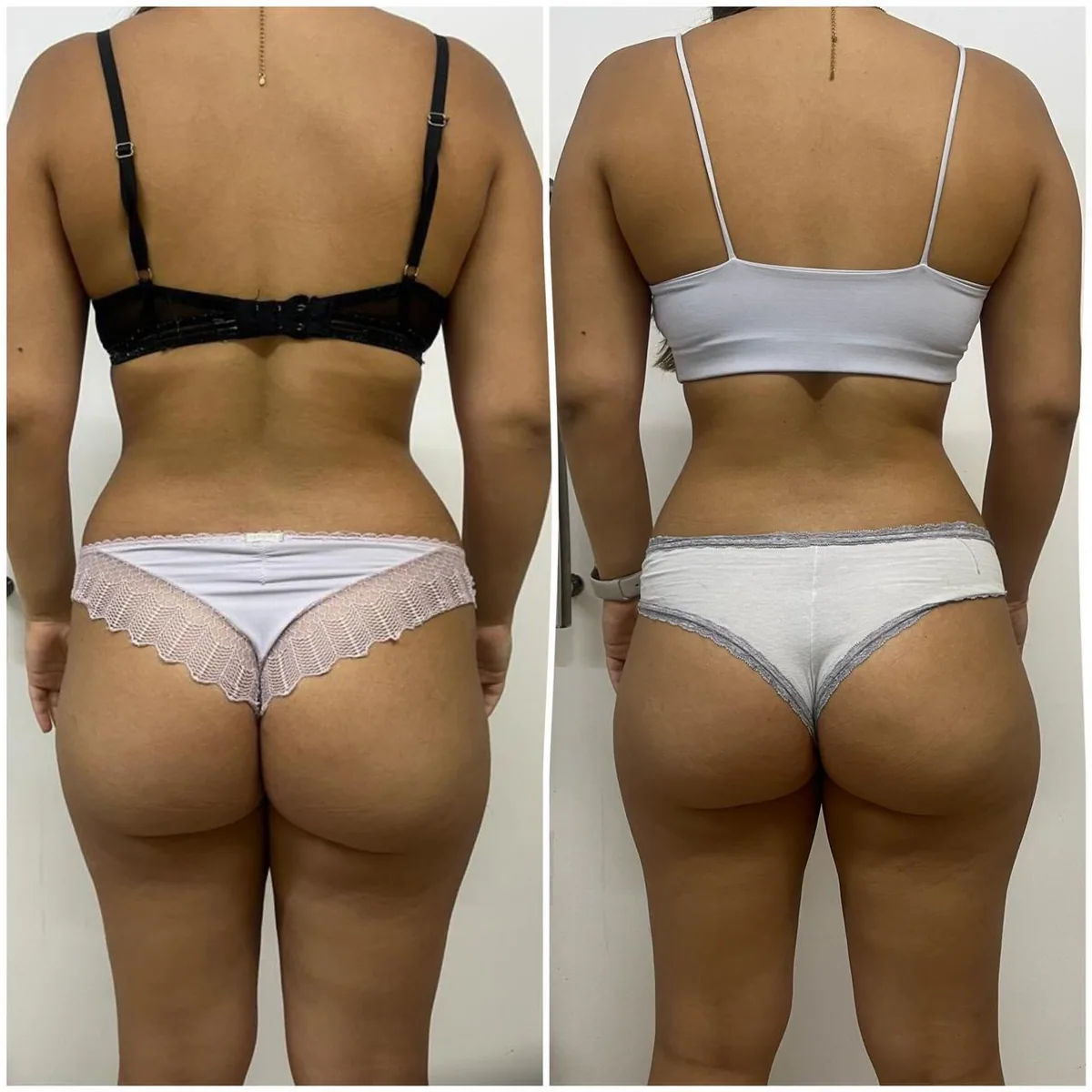 Contorno corporal — abdome