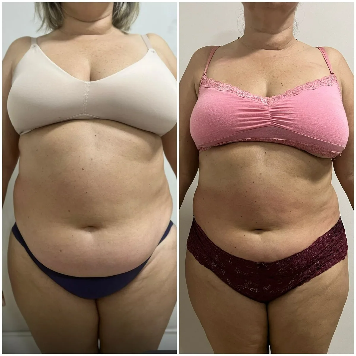 Contorno corporal — pós-protocolo completo