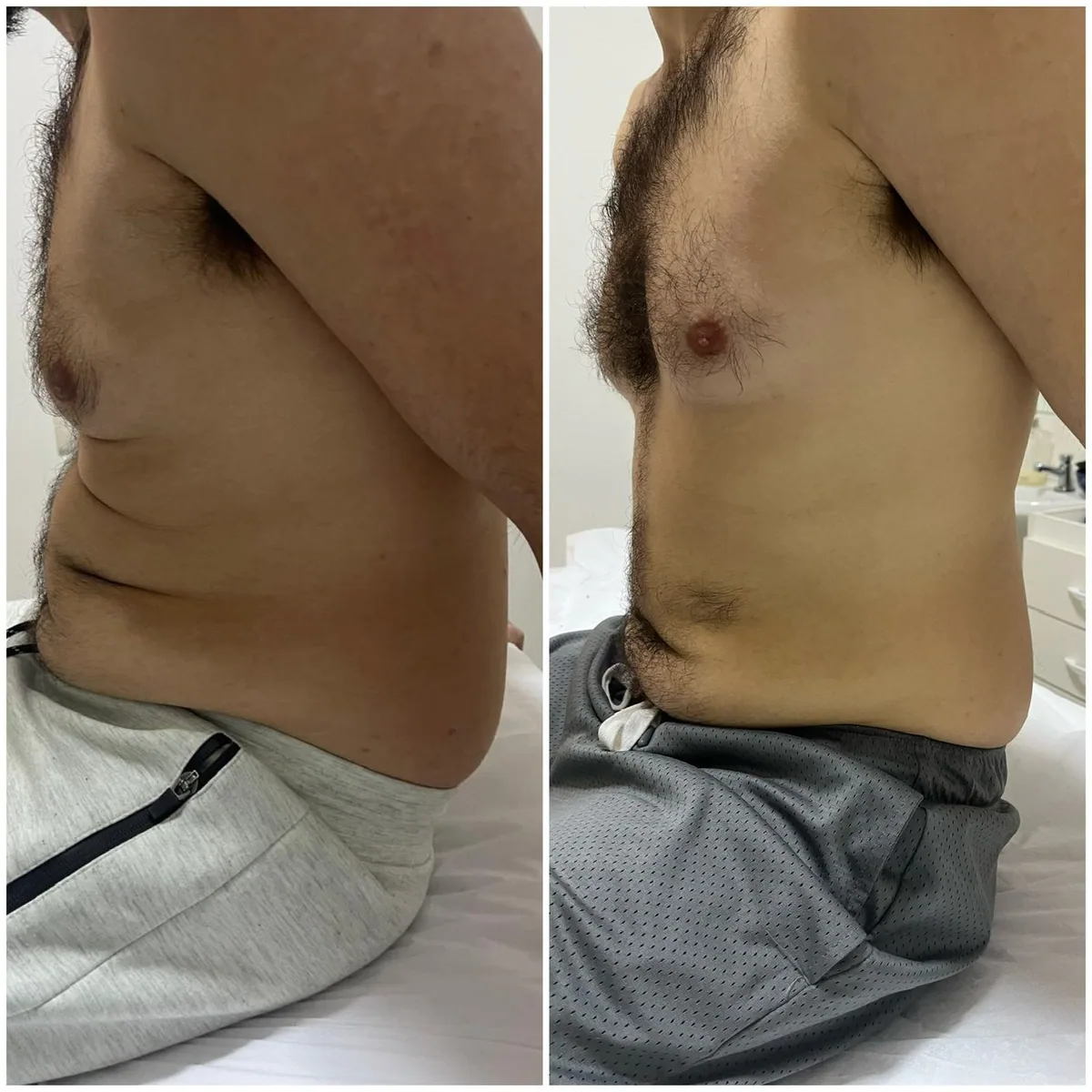 Contorno corporal — abdome