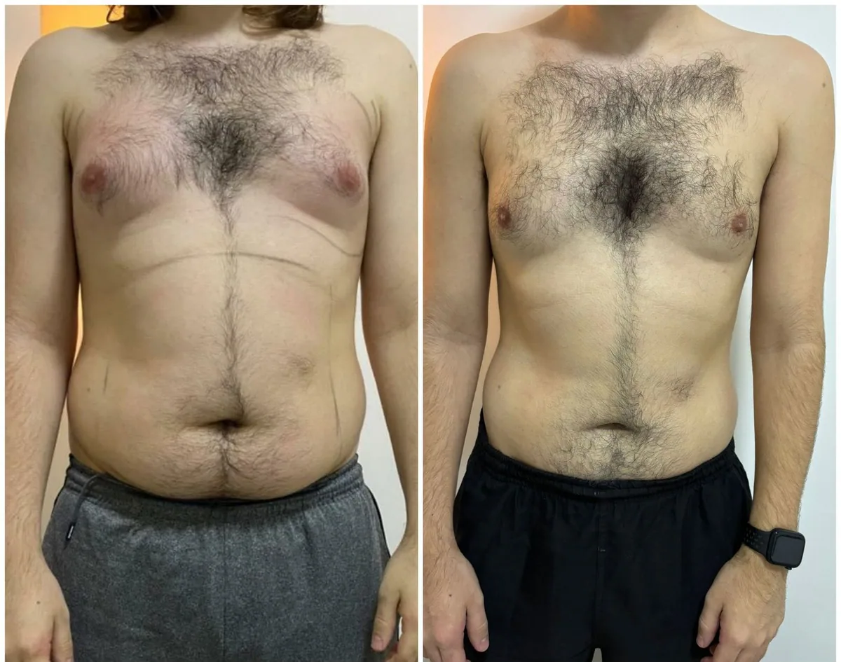 Contorno corporal — pós-protocolo completo