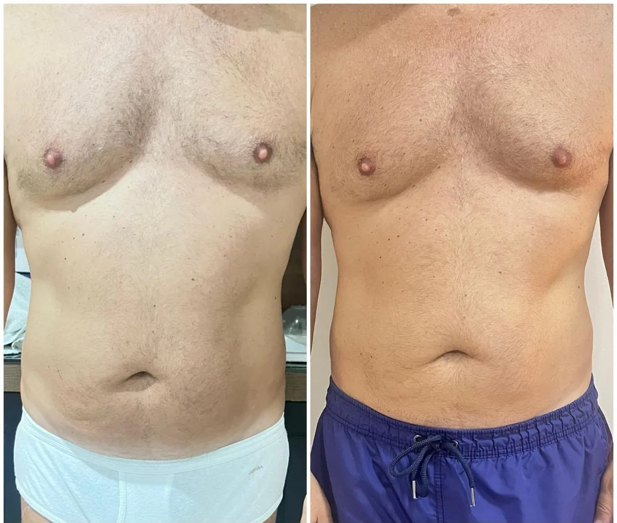 Contorno corporal — abdome