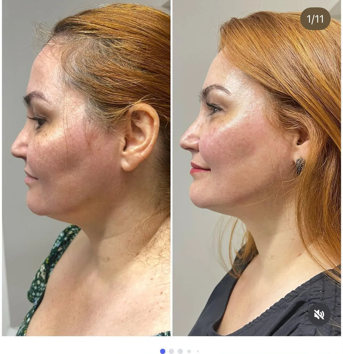 Preenchimento labial