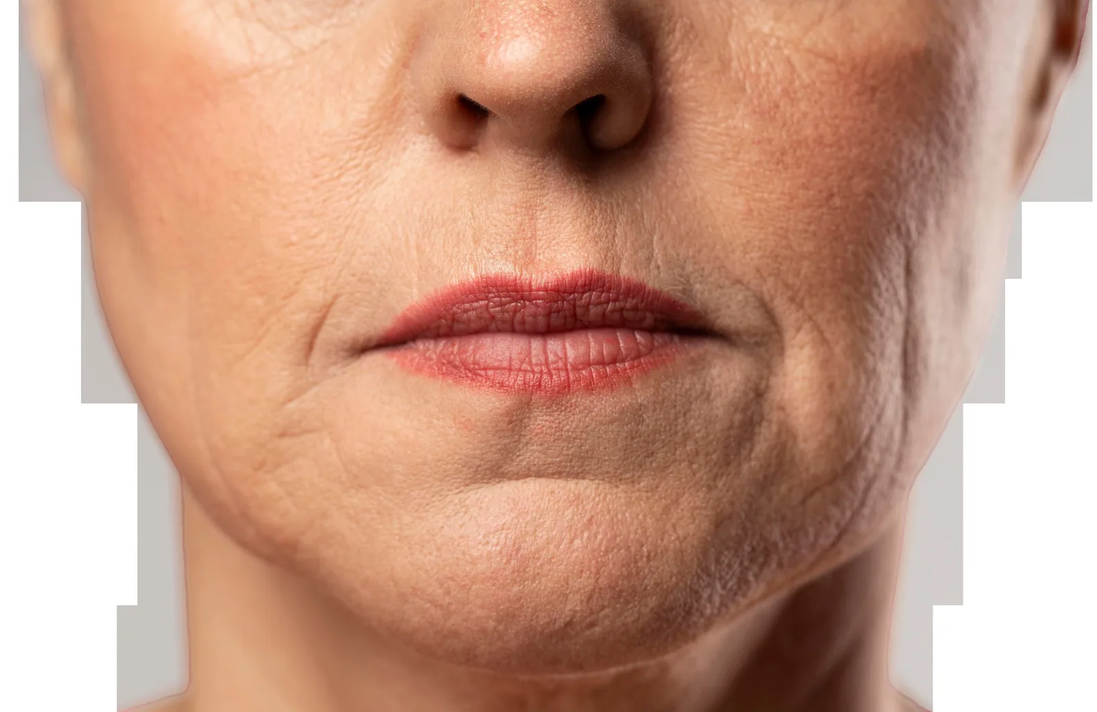 Ultraformer — tratamento estético na Santa Beleza, Moema